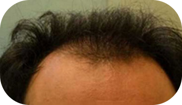 Hair-Transplant-in-Houston-17 2