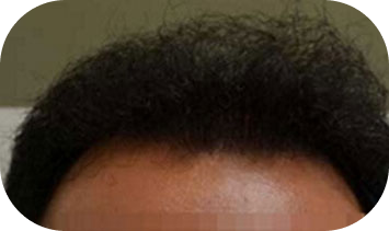 Hair-Transplant-in-Houston-17 3