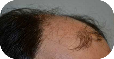 Hair-Transplant-in-Houston-18 1