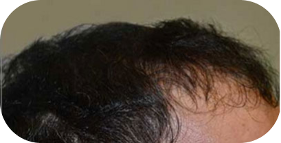 Hair-Transplant-in-Houston-18 3